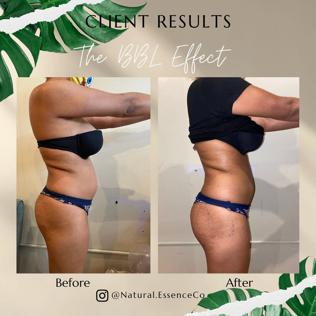 The BBL Effect (Stomach & Booty)